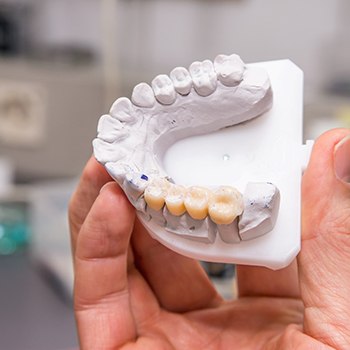 A dental bridge sitting in a jaw mold