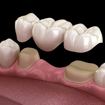 A 3D illustration of a traditional dental bridge