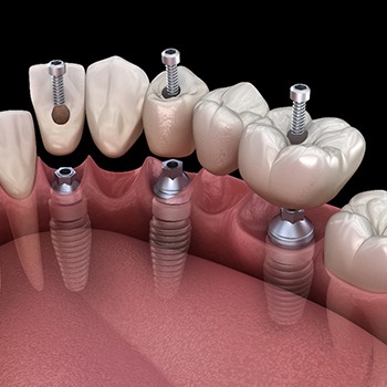 A 3D illustration of an implant bridge