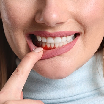 A woman revealing her red and inflamed gums